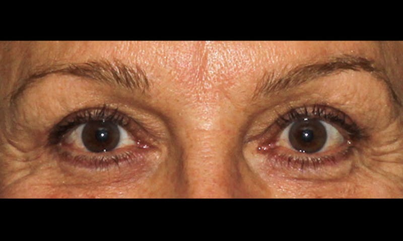 Eyelid Surgery Before & After Gallery - Patient 133023878 - Image 2