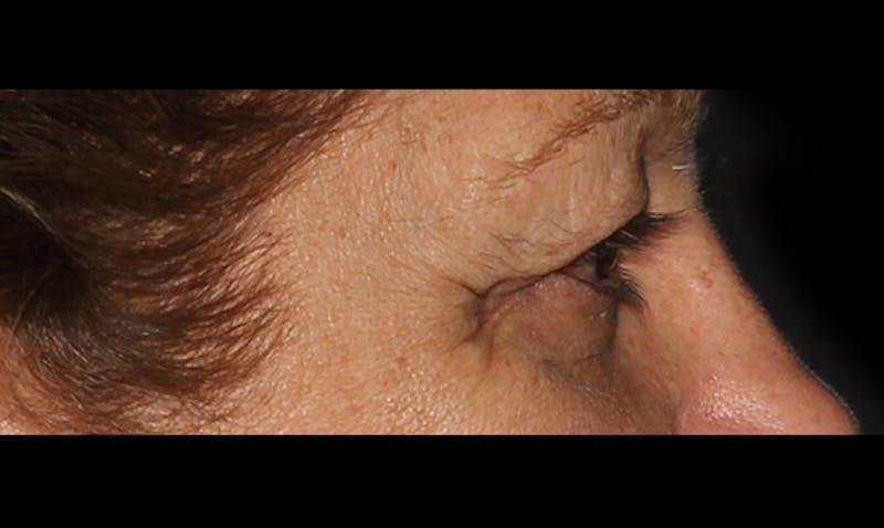 Eyelid Surgery Before & After Gallery - Patient 133023878 - Image 3