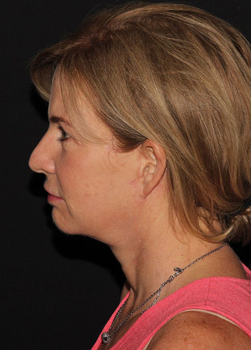 Chin Implants Before & After Gallery - Patient 133023886 - Image 4