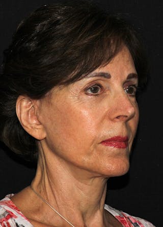 Facelift & Necklift Before & After Gallery - Patient 133023880 - Image 4