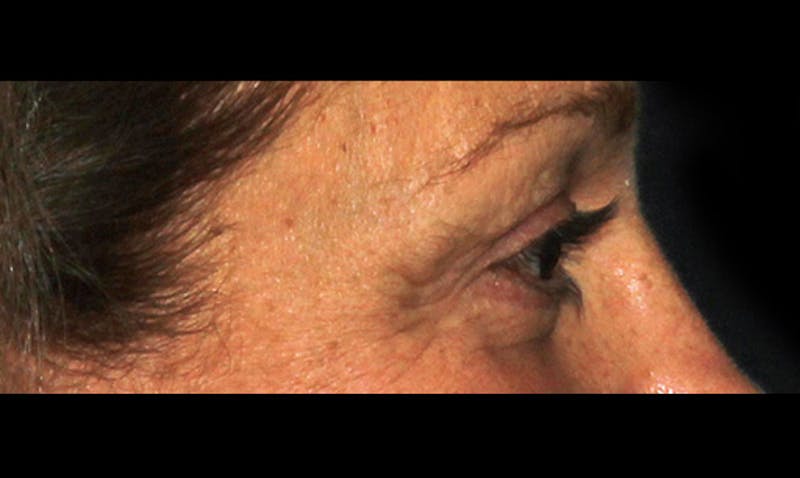 Eyelid Surgery Before & After Gallery - Patient 133023878 - Image 4