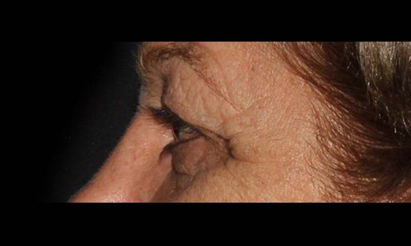 Eyelid Surgery Before & After Gallery - Patient 133023878 - Image 5