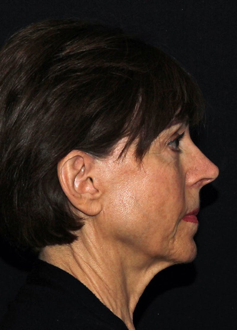 Facelift & Necklift Before & After Gallery - Patient 133023880 - Image 5