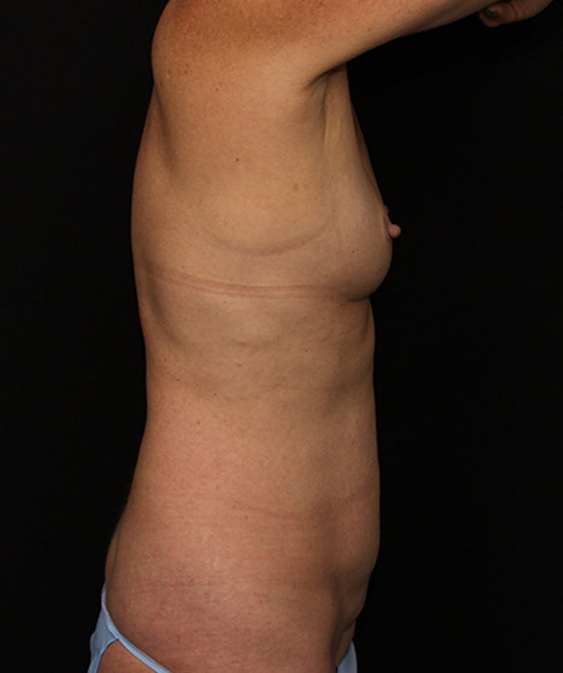 Liposuction Before & After Gallery - Patient 133023879 - Image 9
