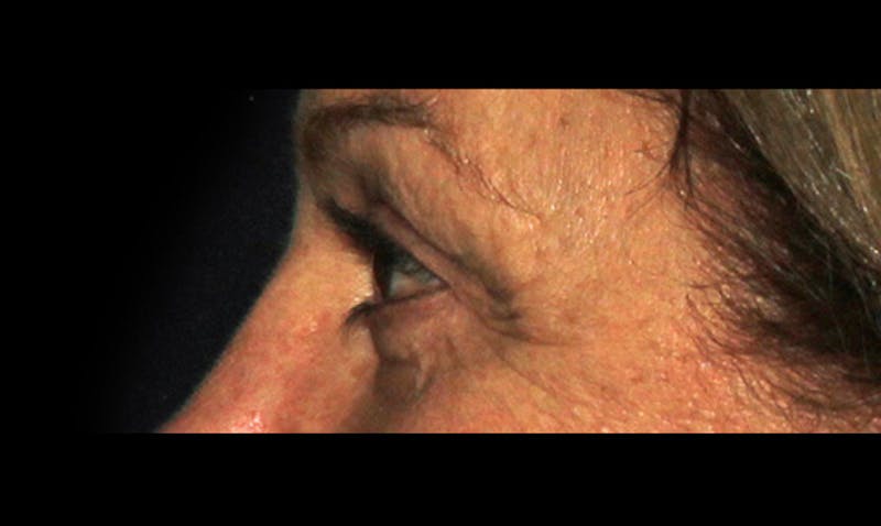 Eyelid Surgery Before & After Gallery - Patient 133023878 - Image 6