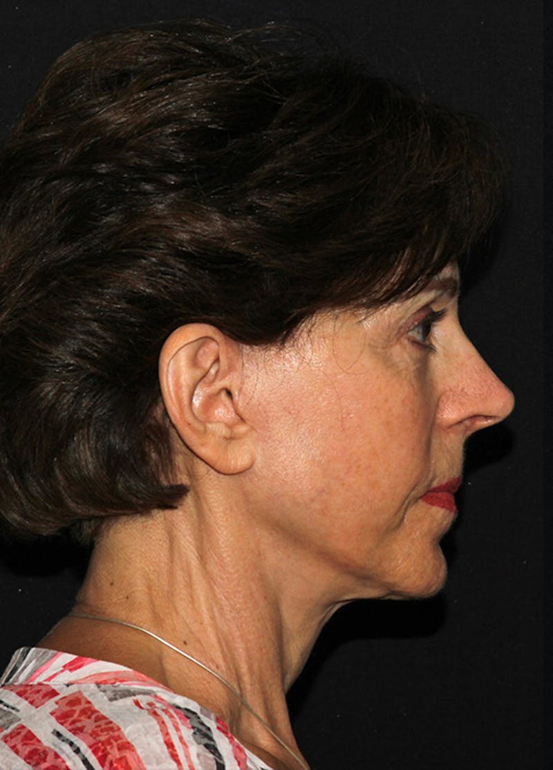 Facelift & Necklift Before & After Gallery - Patient 133023880 - Image 6