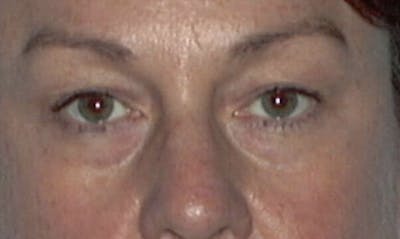 Eyelid Surgery Before & After Gallery - Patient 133023885 - Image 1