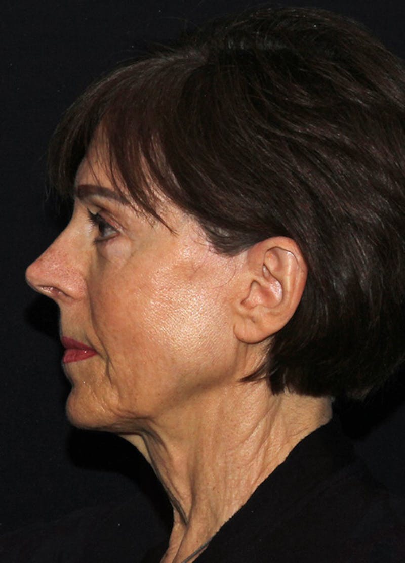 Facelift & Necklift Before & After Gallery - Patient 133023880 - Image 7