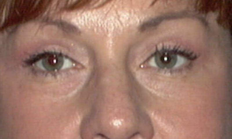 Eyelid Surgery Before & After Gallery - Patient 133023885 - Image 2