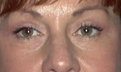 Eyelid Surgery Before & After Gallery - Patient 133023885 - Image 2
