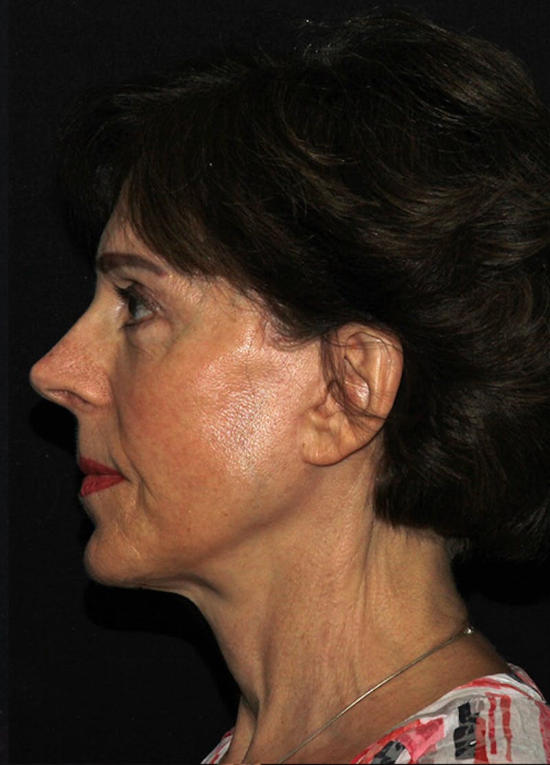 Facelift & Necklift Before & After Gallery - Patient 133023880 - Image 8