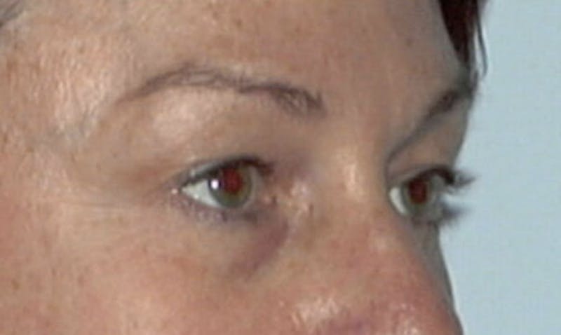 Eyelid Surgery Before & After Gallery - Patient 133023885 - Image 3