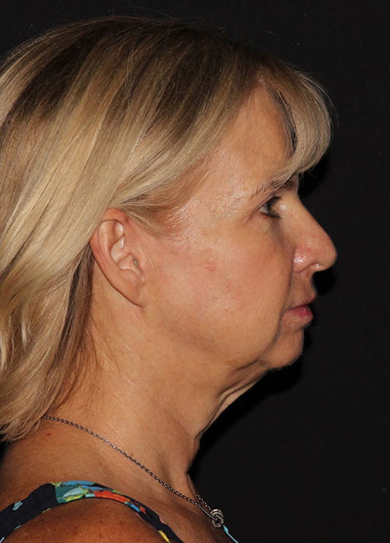 Chin Implants Before & After Gallery - Patient 133023886 - Image 9
