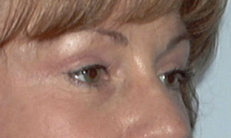 Eyelid Surgery Before & After Gallery - Patient 133023885 - Image 4