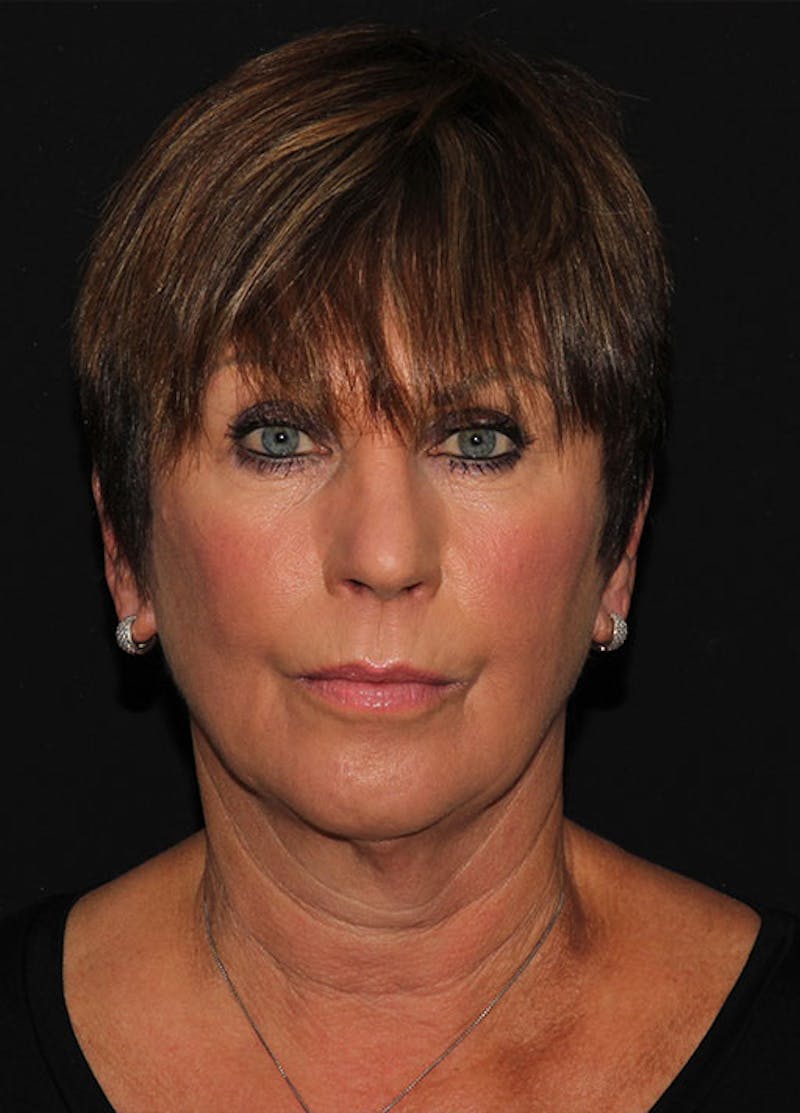 Facelift & Necklift Before & After Gallery - Patient 133023893 - Image 1