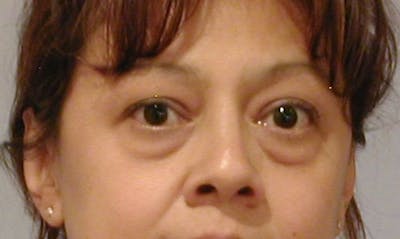 Eyelid Surgery Before & After Gallery - Patient 133023887 - Image 1