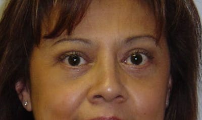 Eyelid Surgery Before & After Gallery - Patient 133023887 - Image 2