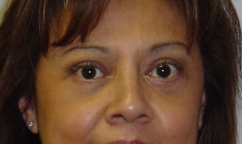 Eyelid Surgery Before & After Gallery - Patient 133023887 - Image 2