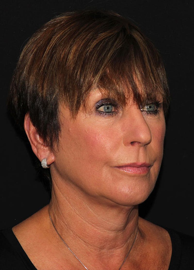Facelift & Necklift Before & After Gallery - Patient 133023893 - Image 3