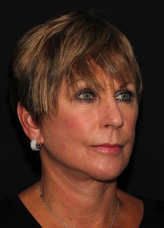 Facelift & Necklift Before & After Gallery - Patient 133023893 - Image 4