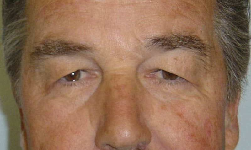 Eyelid Surgery Before & After Gallery - Patient 133023889 - Image 1