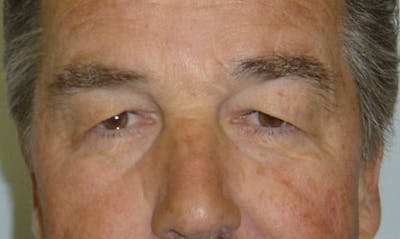 Eyelid Surgery Before & After Gallery - Patient 133023889 - Image 1