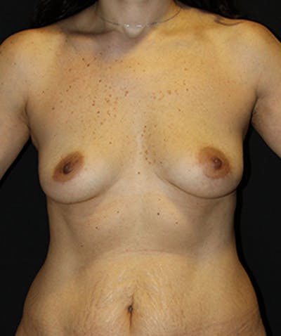 Breast Augmentation Before & After Gallery - Patient 133023901 - Image 1