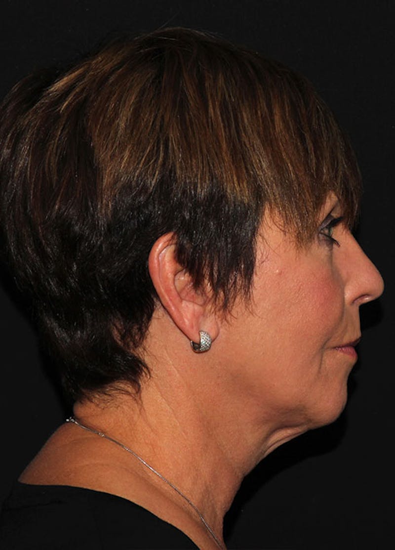Facelift & Necklift Before & After Gallery - Patient 133023893 - Image 5