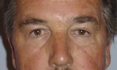 Eyelid Surgery Before & After Gallery - Patient 133023889 - Image 2