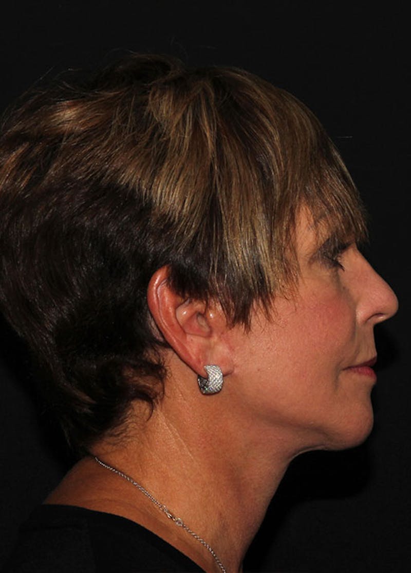 Facelift & Necklift Before & After Gallery - Patient 133023893 - Image 6