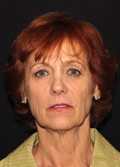 Facelift & Necklift Before & After Gallery - Patient 133023899 - Image 1