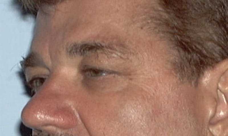 Eyelid Surgery Before & After Gallery - Patient 133023894 - Image 3
