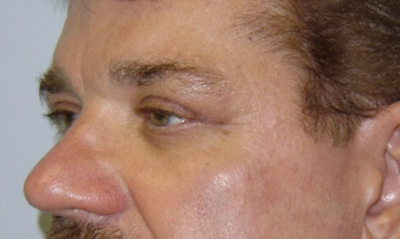 Eyelid Surgery Before & After Gallery - Patient 133023894 - Image 4