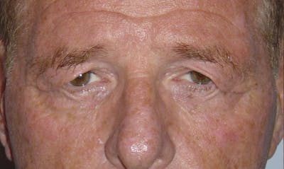 Eyelid Surgery Before & After Gallery - Patient 133023897 - Image 1
