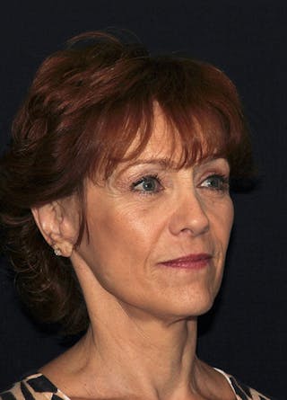 Facelift & Necklift Before & After Gallery - Patient 133023899 - Image 4