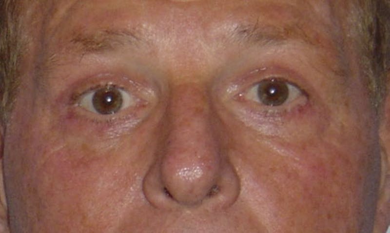 Eyelid Surgery Before & After Gallery - Patient 133023897 - Image 2