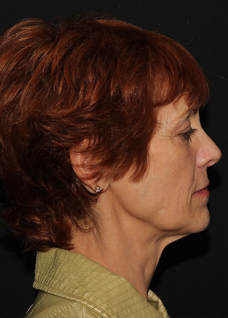 Facelift & Necklift Before & After Gallery - Patient 133023899 - Image 5