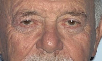 Eyelid Surgery Before & After Gallery - Patient 133023900 - Image 1