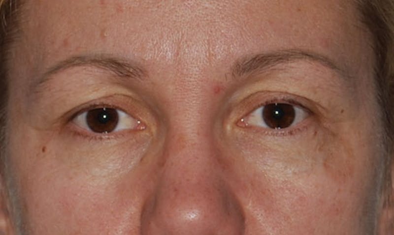 Eyelid Surgery Before & After Gallery - Patient 133023902 - Image 1