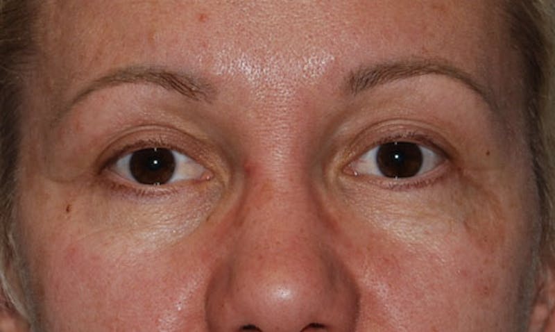Eyelid Surgery Before & After Gallery - Patient 133023902 - Image 2