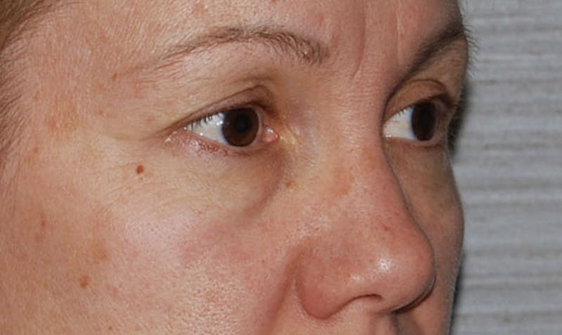 Eyelid Surgery Before & After Gallery - Patient 133023902 - Image 3
