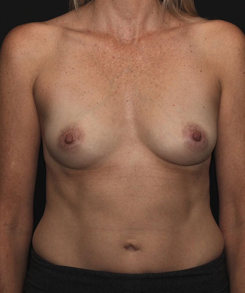 Breast Augmentation Before & After Gallery - Patient 133023907 - Image 1