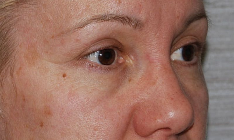 Eyelid Surgery Before & After Gallery - Patient 133023902 - Image 4