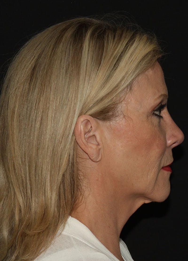 Facelift & Necklift Before & After Gallery - Patient 133023903 - Image 5
