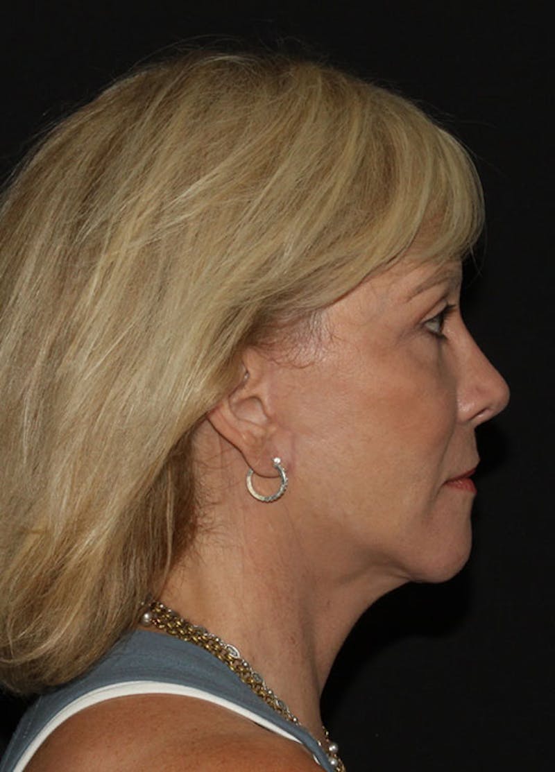 Facelift & Necklift Before & After Gallery - Patient 133023903 - Image 6