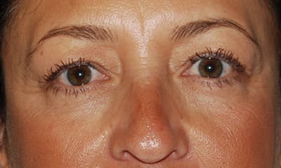 Eyelid Surgery Before & After Gallery - Patient 133023904 - Image 1