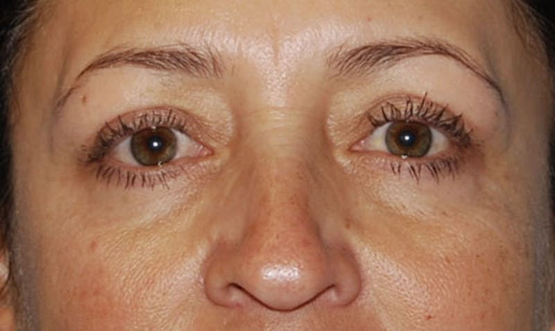 Eyelid Surgery Before & After Gallery - Patient 133023904 - Image 2