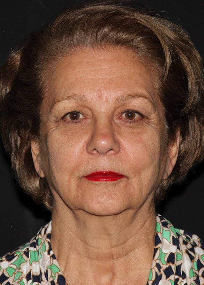 Facelift & Necklift Before & After Gallery - Patient 133023908 - Image 1