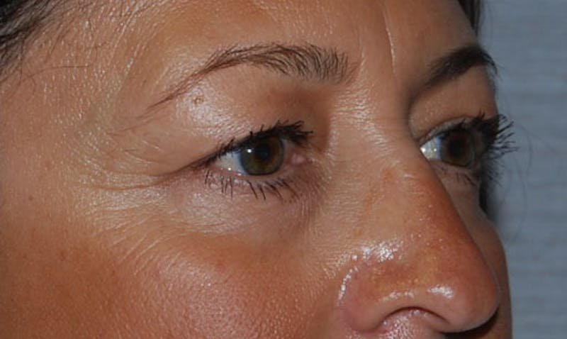 Eyelid Surgery Before & After Gallery - Patient 133023904 - Image 3