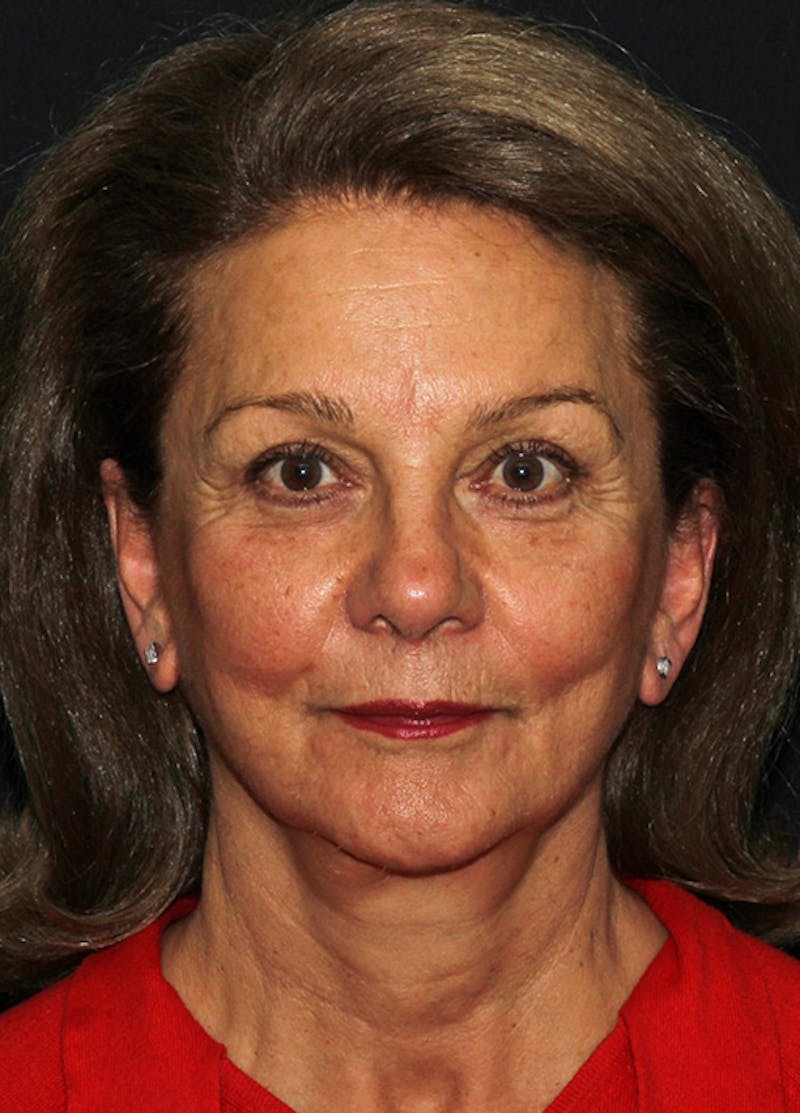 Facelift & Necklift Before & After Gallery - Patient 133023908 - Image 2